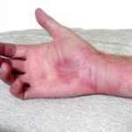 Alergia al frío: síntomas y tratamientos eficaces
