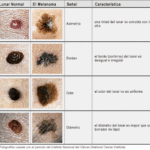 Cómo identificar lunares y pecas con relieve en la piel