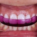 Cómo prevenir y tratar el desgaste dental por bruxismo