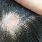 Cuál es la razón natural detrás de la caída del cabello