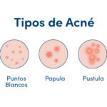 Cuáles son los tipos de acné facial y cómo se pueden tratar
