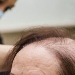 Cuáles son los tipos de alopecia más comunes en mujeres