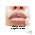 Labios cortados y agrietados: causas y tratamientos