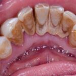 Placa dental y sarro: diferencias y eliminación eficaz