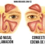 Qué causa la congestión nasal nocturna sin gripe