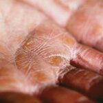 Xerosis: Qué es y cómo tratar la sequedad en la piel